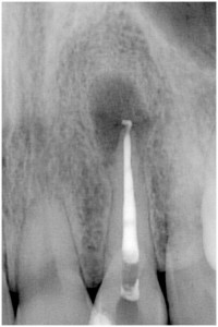 小泉②-2　根管充填